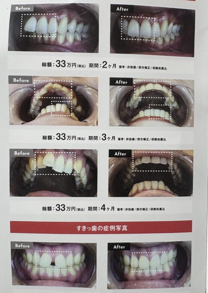 Before-and-after comparison photos showing orthodontic treatment results for various dental misalignments, with cost and treatment period in Japanese.