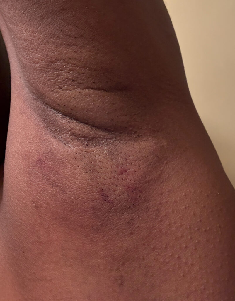 Underarm skin showing post-MiraDry swelling and texture changes during the healing process