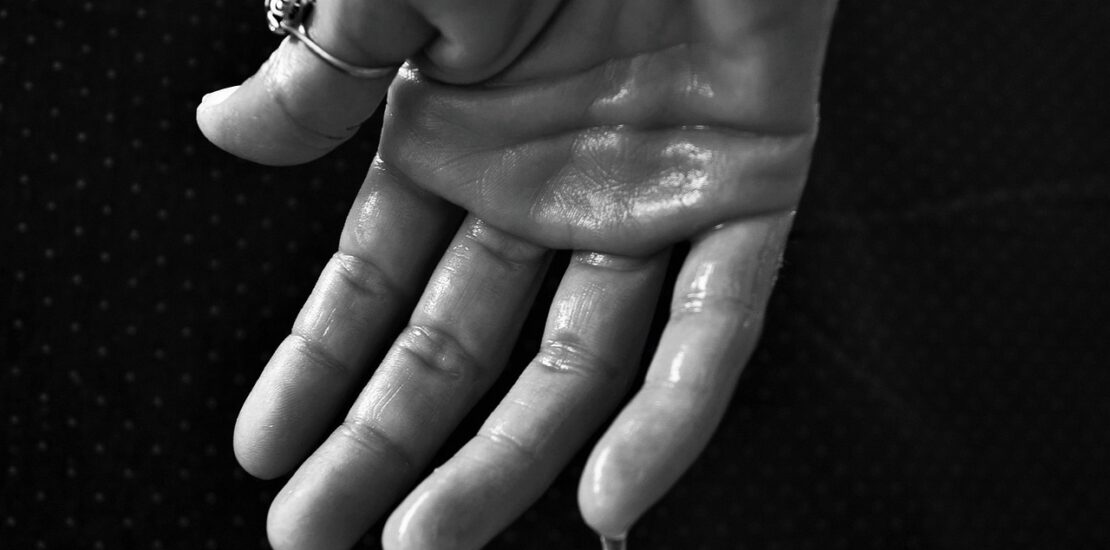 Hand with visible sweat droplets symbolizing excessive sweating before sweat gland removal
