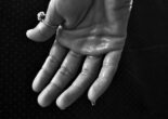 Hand with visible sweat droplets symbolizing excessive sweating before sweat gland removal
