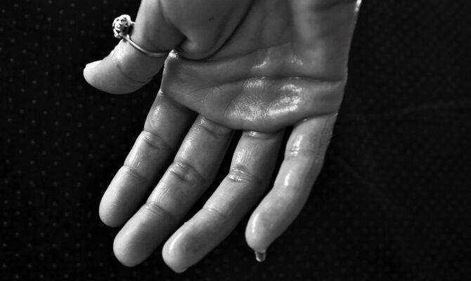 Hand with visible sweat droplets symbolizing excessive sweating before sweat gland removal