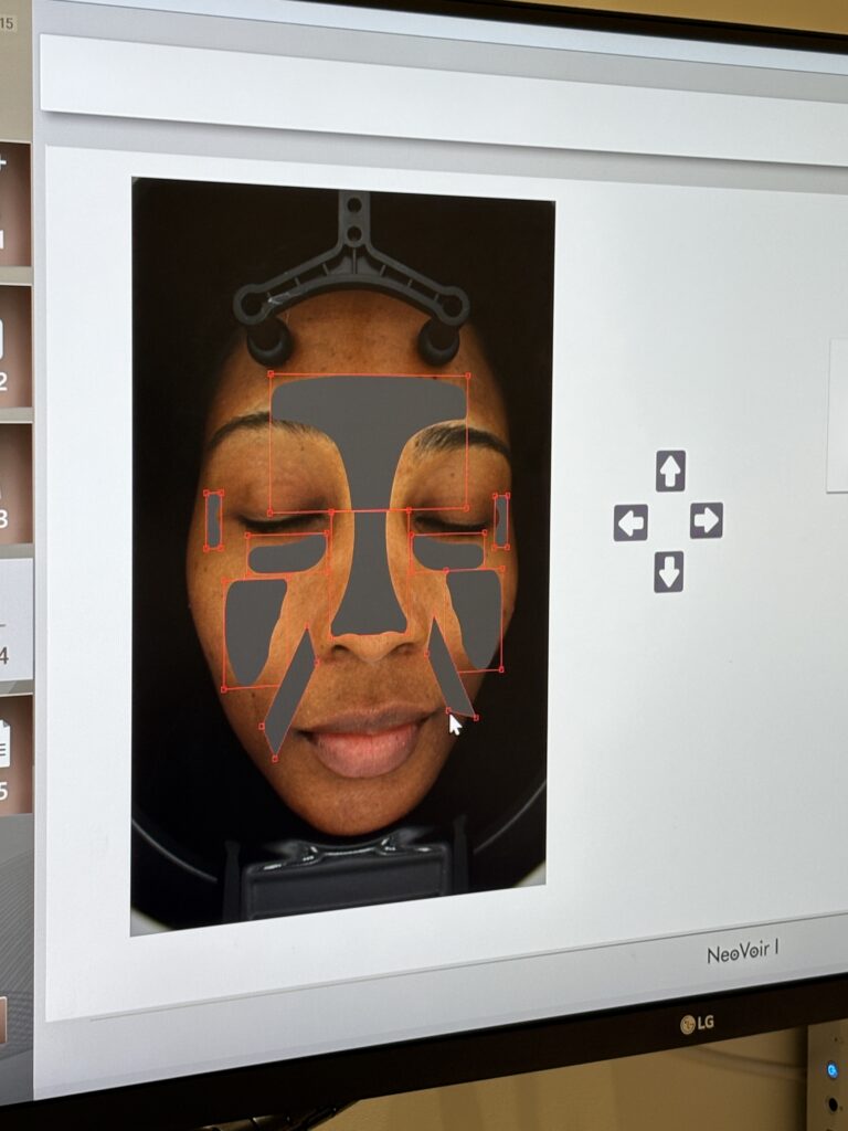 Close-up of a skin analysis screen showing a woman’s face with highlighted facial zones used to assess wrinkles and skin condition.