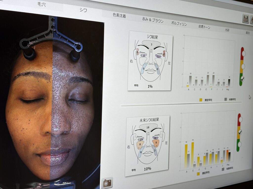 Skin analysis results displayed on a monitor showing wrinkle mapping, future skin predictions, and facial condition data.